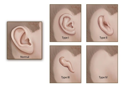 stages ear microtia