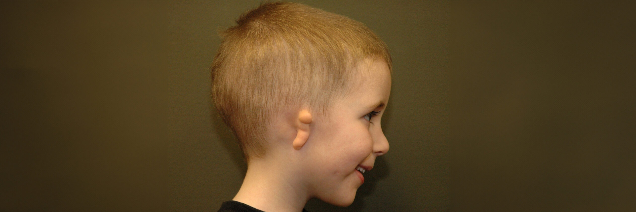 Kid with Microtia