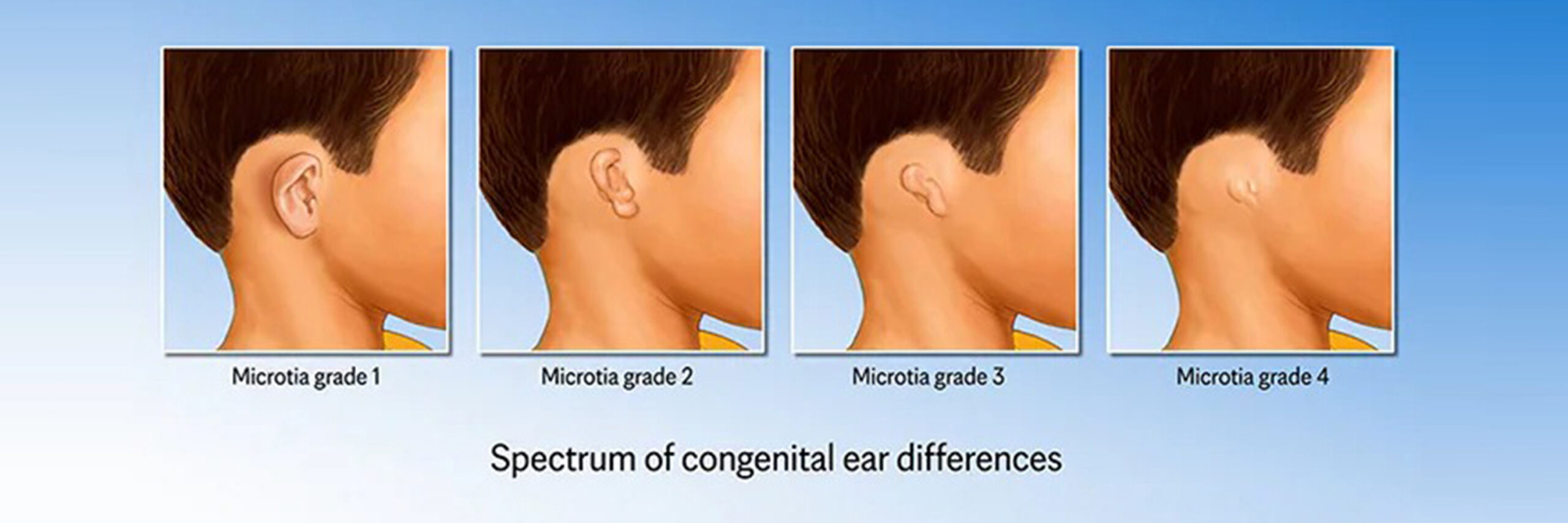 Stages of Microtia